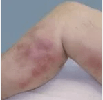 Diagnostika a komplikácie kŕčových žíl