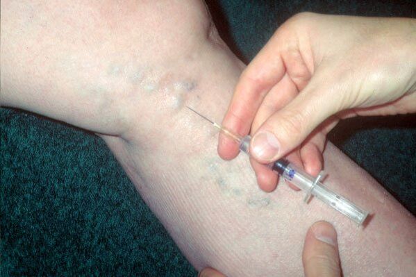 skleroterapia na kŕčové žily