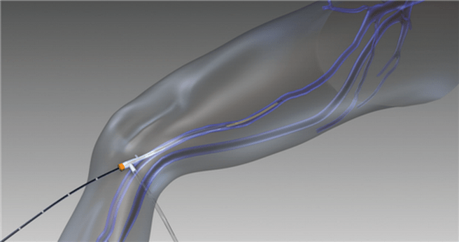 rádiofrekvenčná obliterácia pre kŕčové žily