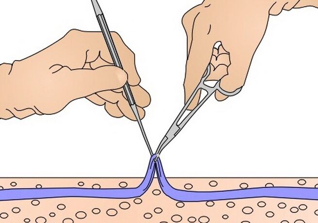 stripovanie žíl na kŕčové žily